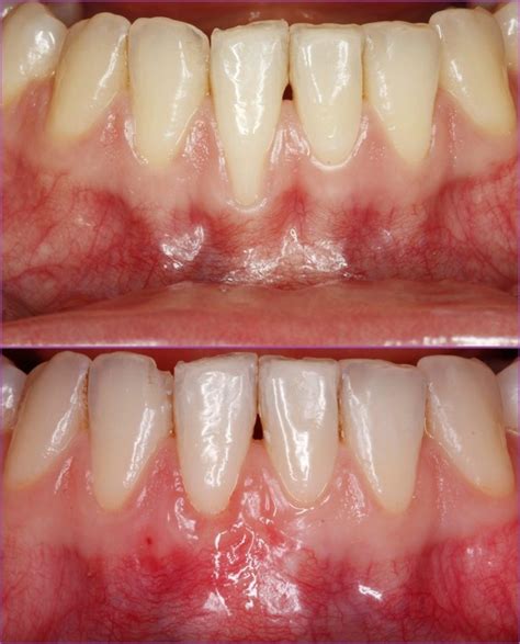 gum recession treatment conroe  But there are causes that contribute to receding gums